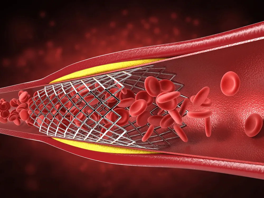 Unsure If You Need a Stent?  Get a Second Opinion