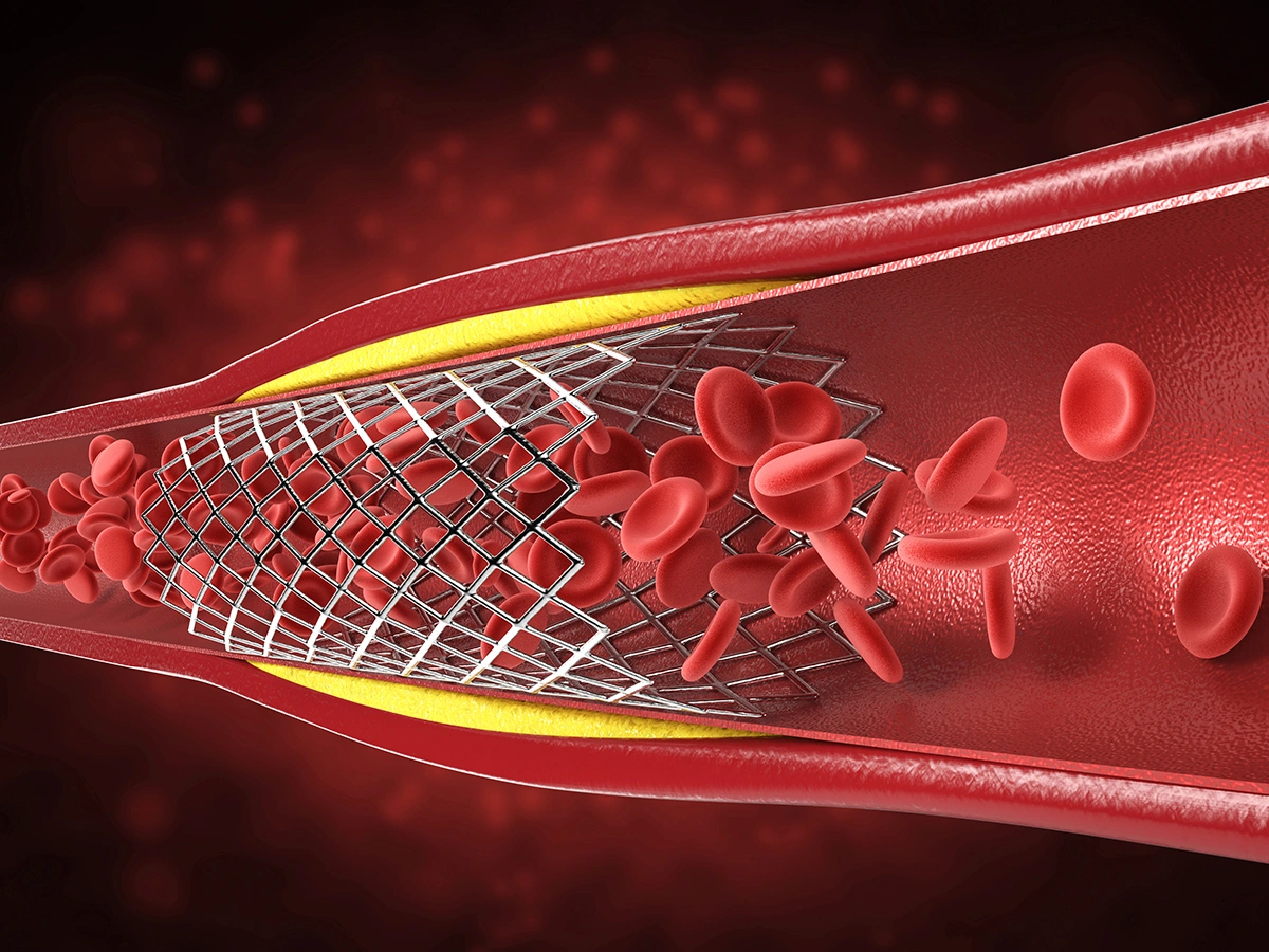 Unsure If You Need a Stent? Get a Second Opinion